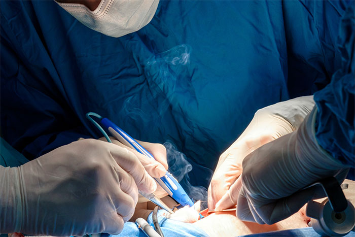 Let’s Clear the Air Between Us: Safe and Effective Surgical Smoke Evacuation - Webinar